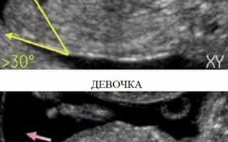 Отличия мальчиков и девочек по УЗИ