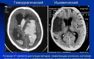 Отличие КТ от МРТ головного мозга