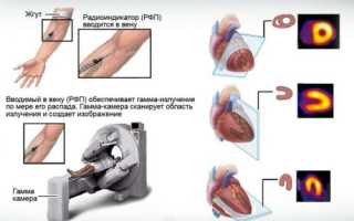 Сцинтиграфия миокарда