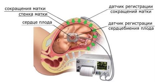 КТГ плода