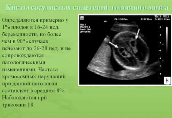 Кисты головного мозга