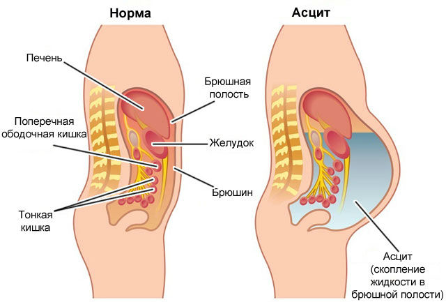 Асцит
